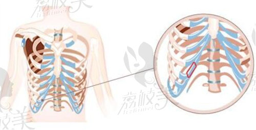 西安高一生整形肋骨鼻綜合價格多錢？