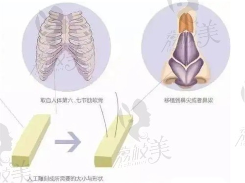 南京美贝尔陈刚医生做半肋软骨隆鼻技术不错