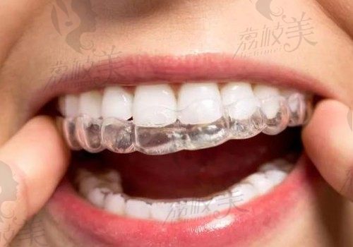 矫正牙齿后保持器要戴多久？