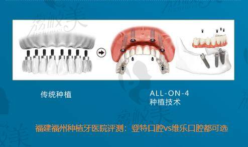 福建福州种植牙医院评测：登特口腔vs维乐口腔都可选