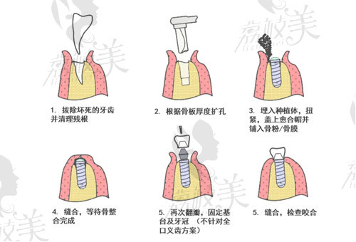 上海摩尔口腔医院浦东分院种植牙技术