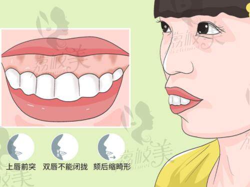 高伟医生做骨性凸嘴手术技术好