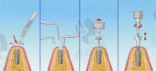 株洲种植牙多少钱一颗2023