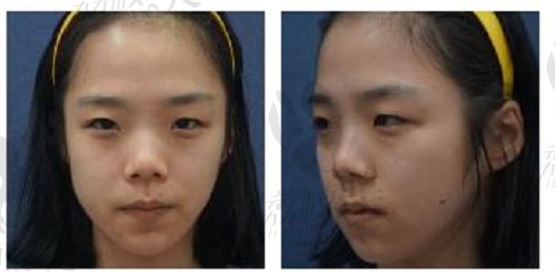 在韩国伊美芝做眼鼻手术前