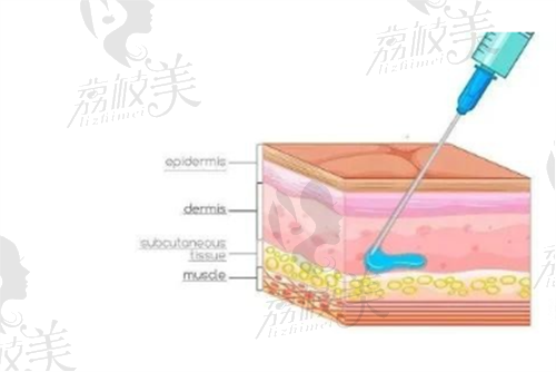 玻尿酸是什么