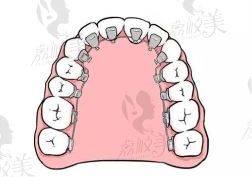 广州柏德口腔可做舌侧矫正