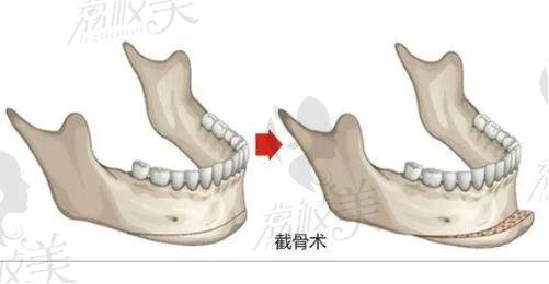 武漢付國友磨骨怎么樣