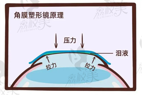 角膜塑形镜是不是ok镜