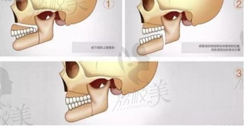 顴骨顴弓銳L型截骨技術(shù)