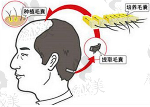 青島熙朵頭發(fā)移植怎么樣？