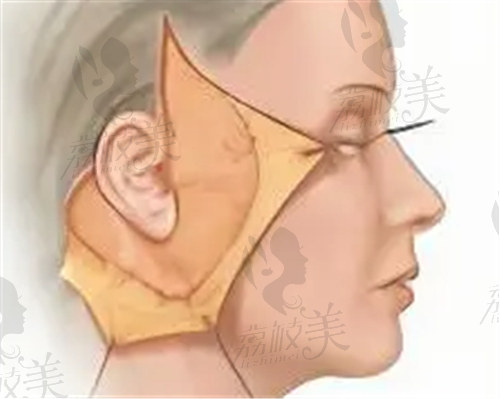 辽宁曙光整形外科医院做面部提拉手术的优势