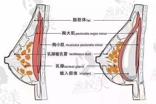 北京嘉禾董巖巖醫(yī)生假體隆胸技術(shù)優(yōu)勢