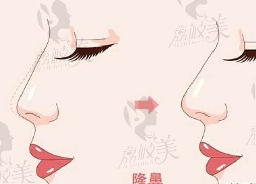 杭州艺星徐利刚做鼻子有哪些技术优势