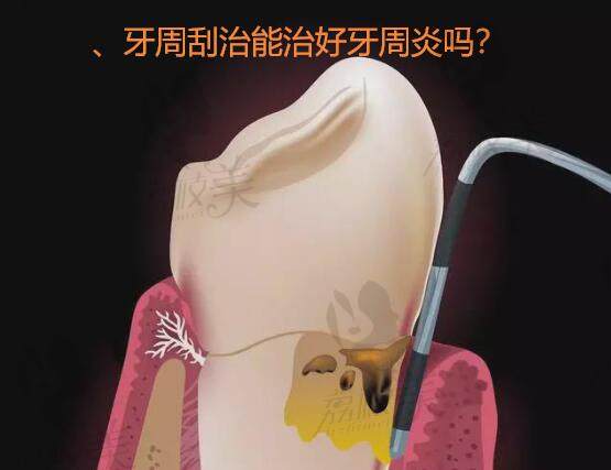 、牙周刮治能治好牙周炎吗？