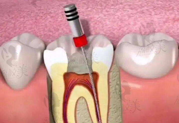牙髓如果还活着千万别做根管治疗