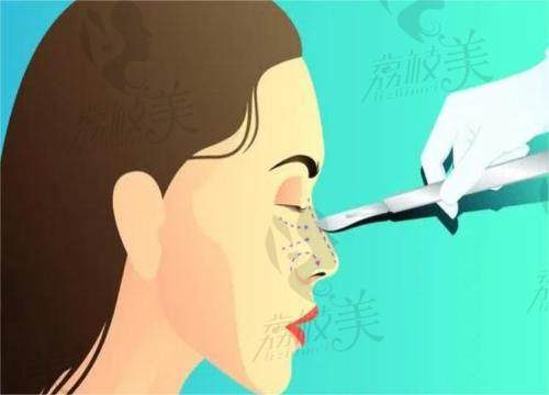 杭州艺星汪云峰医生做鼻子技术好在哪里