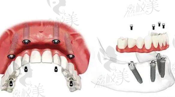 ALL-ON-6即刻种植牙技术