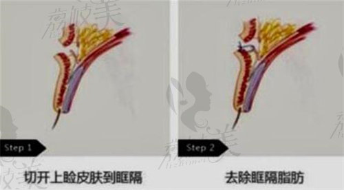 双眼皮切开去除框格脂肪