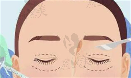韩 式双眼皮和埋线双眼皮区别是什么？