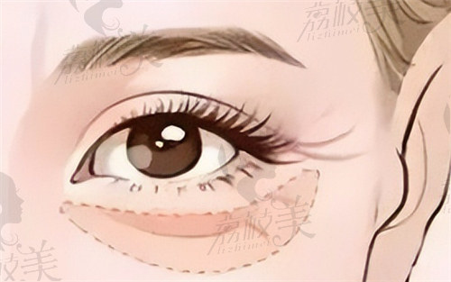 韩 式双眼皮与埋线双眼皮哪个好看呢？