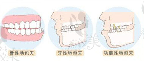 牙齿畸形还是骨性畸形