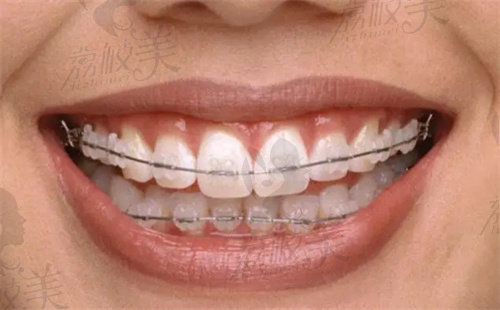龅牙矫正牙齿的全部过程