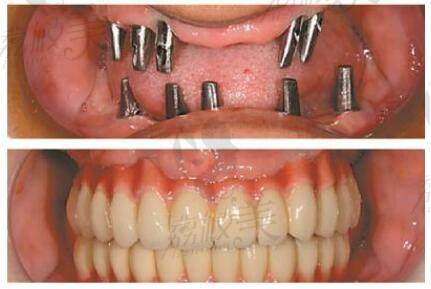 骨量不足也可以进行种植牙获得口腔健康