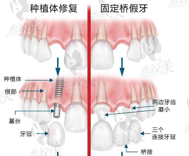 义齿与种植牙的对比