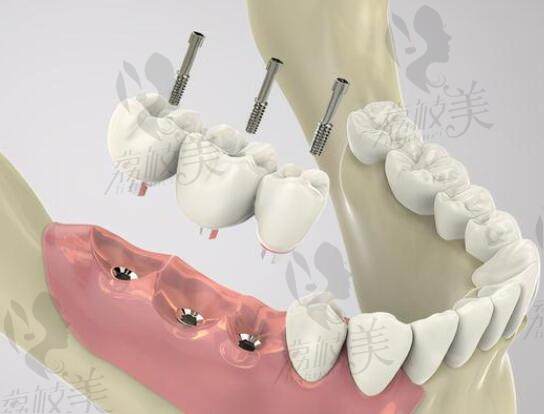 种植牙可以解决多了牙齿缺失问题