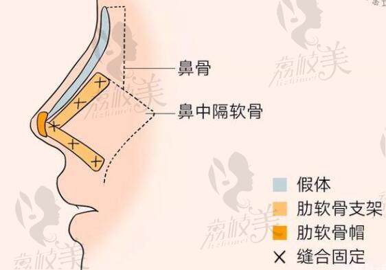 肋软骨隆鼻优势