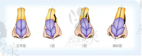 南京苏王整容王兵医生修复失败隆鼻很自然