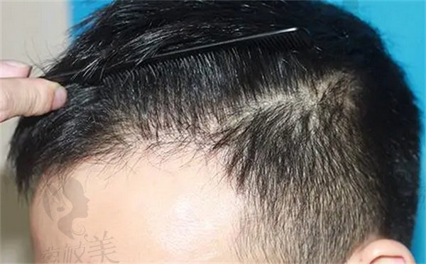 毛囊克隆植发技术成熟吗？