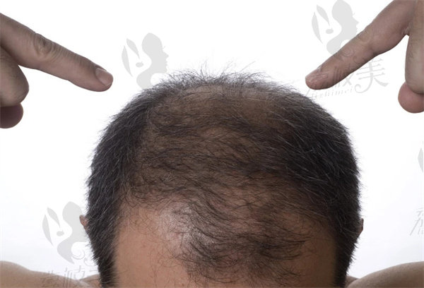 毛囊克隆植发技术成熟吗？