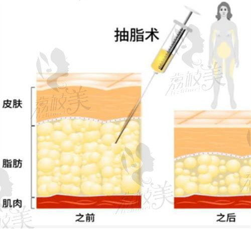 濟(jì)南海峽整形醫(yī)院吸脂技術(shù)怎么樣？