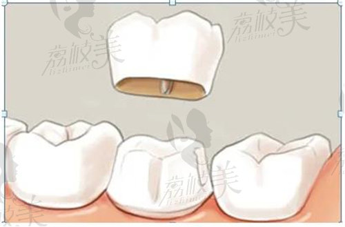 成都烤瓷牙冠多少钱一颗