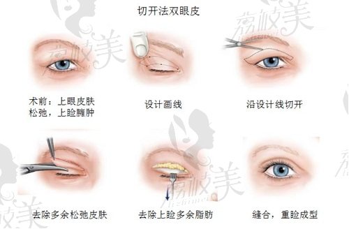 東莞臺心醫(yī)院美容科牛子林醫(yī)生雙眼皮怎么樣