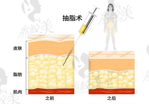 长春艾尔莎整形医院吸脂塑形收费价格表