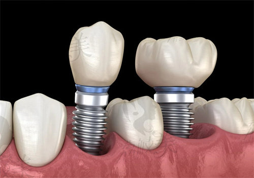 上海种植牙多少钱