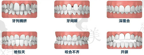 沈阳牙齿矫正大概多少钱