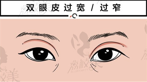 广州韩后美容医院修复双眼皮技术如何