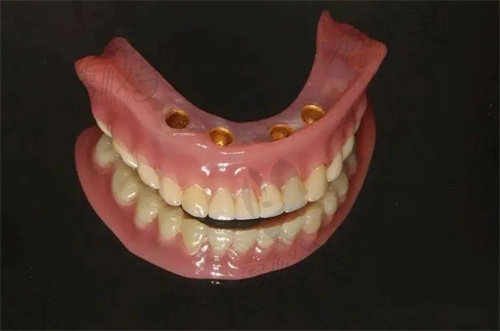覆盖义齿和种植牙区别
