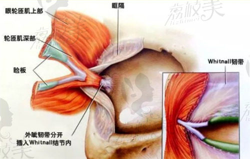 广州美莱做双眼皮技术好