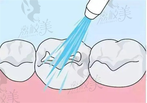 2023福州补牙价格