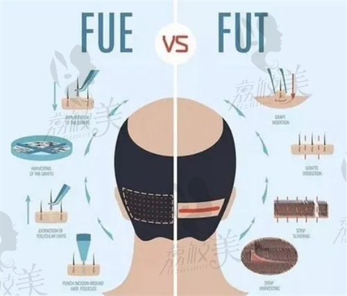 深圳鹏程医院FUE技术