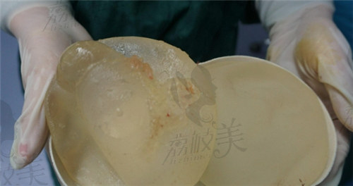 上海胸部假体取出医院排名