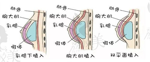 广州华美整形丰胸贵不贵