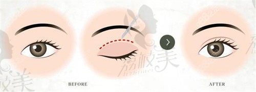 東莞壹加壹醫(yī)療美容醫(yī)院王峰做的雙眼皮怎么樣？簡歷|口碑|價格分析