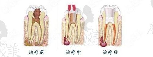 牙髓炎的表现症状有哪些