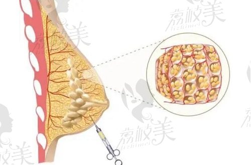 北京英煌自体脂肪丰胸技术