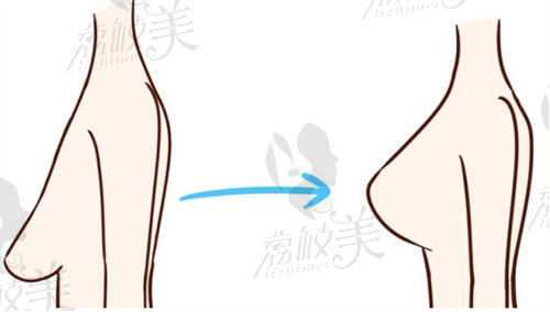 李高峰医生乳房下垂矫正技术怎么样？